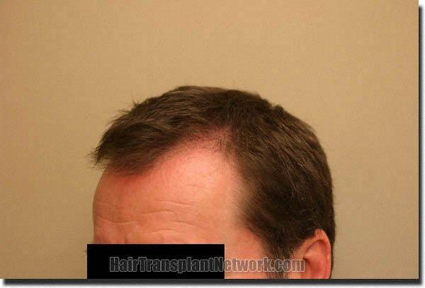 Hair restoration procedure results