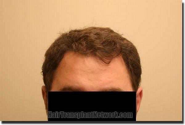 Hair restoration procedure results