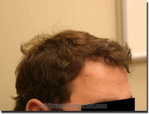 Hair restoration procedure results