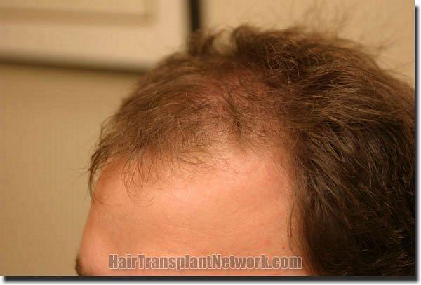 Hair restoration procedure results