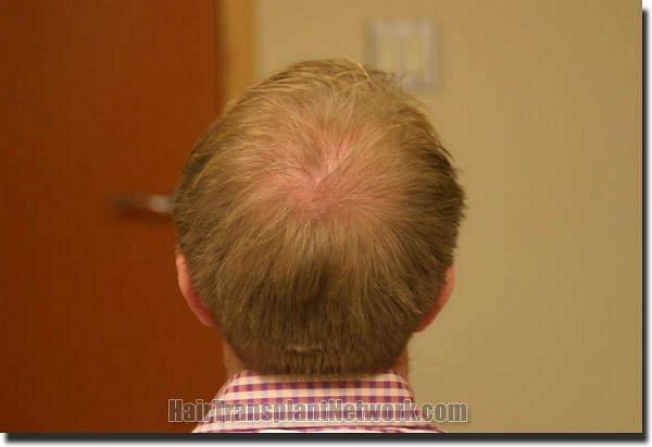 Hair restoration procedure results