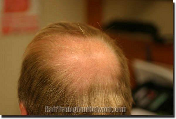 Hair restoration procedure results