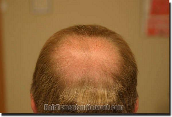 Hair restoration procedure results