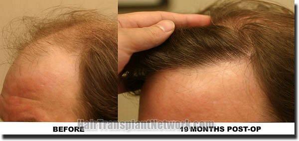 Hair restoration procedure results