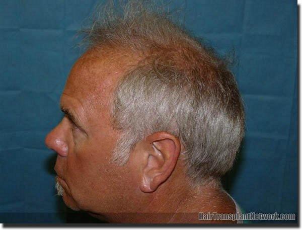 Hair restoration procedure results