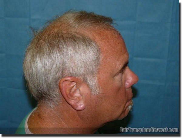 Hair restoration procedure results