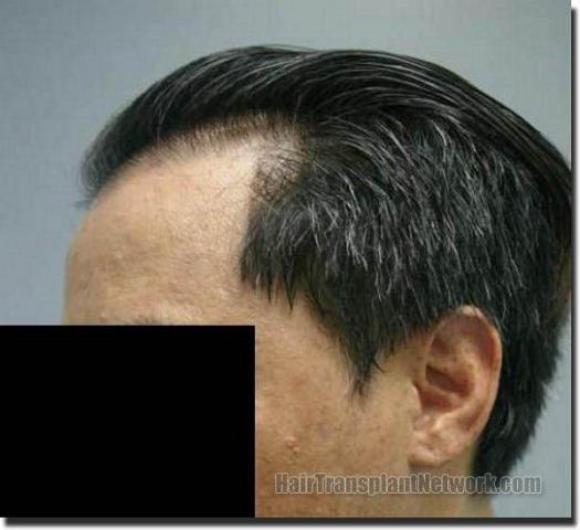 Hair restoration procedure results