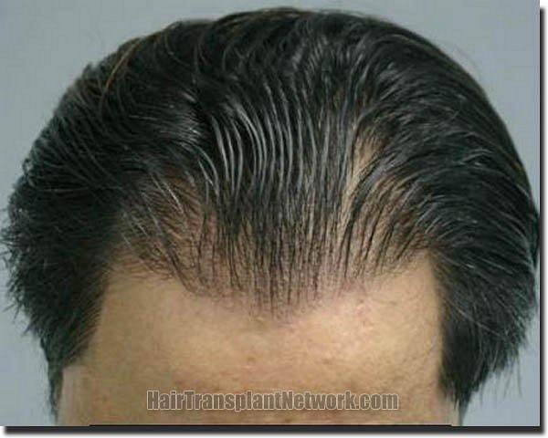 Hair restoration procedure results