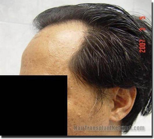 Hair restoration procedure results