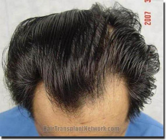 Hair restoration procedure results