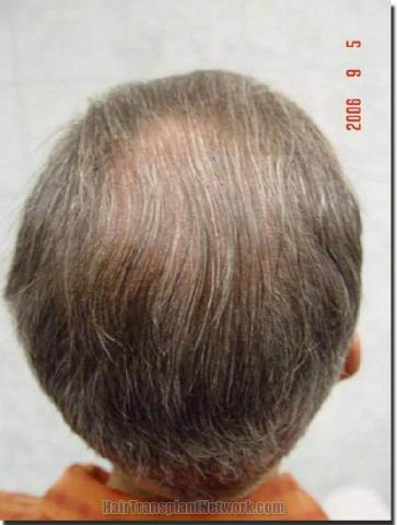 Hair restoration procedure results