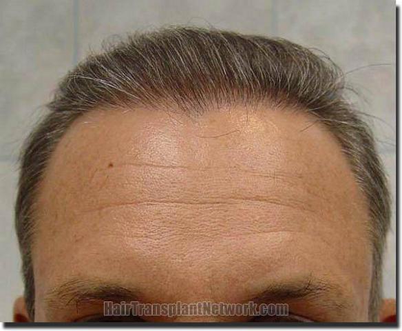 Hair restoration procedure results