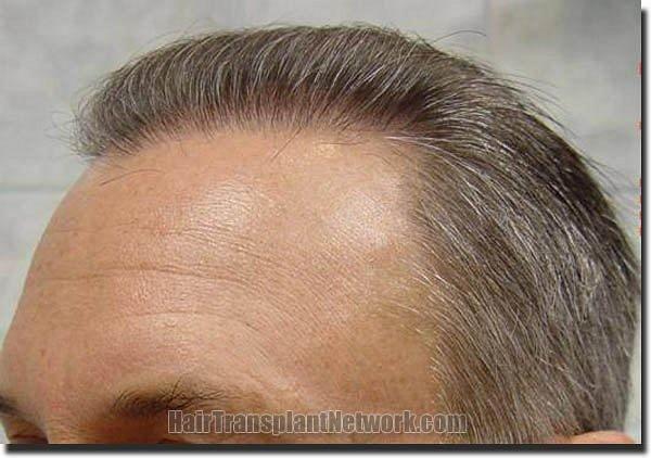 Hair restoration procedure results