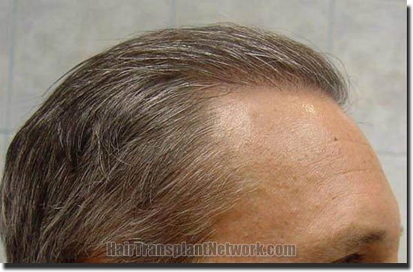 Hair restoration procedure results