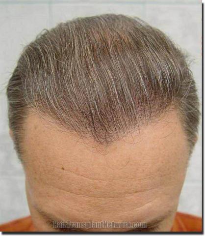 Hair restoration procedure results