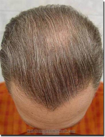 Hair restoration procedure results