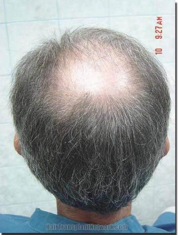 Hair restoration procedure results