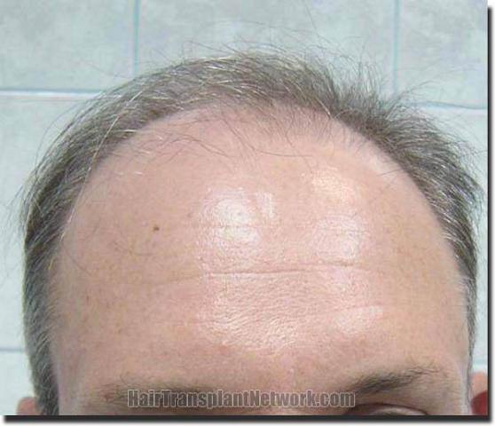 Hair restoration procedure results