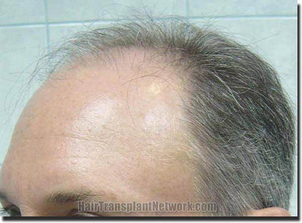 Hair restoration procedure results