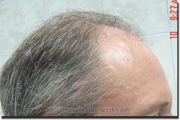 Hair restoration procedure results