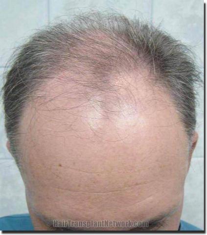 Hair restoration procedure results