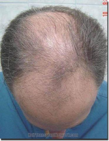 Hair restoration procedure results