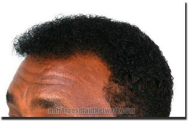 Hair restoration procedure results