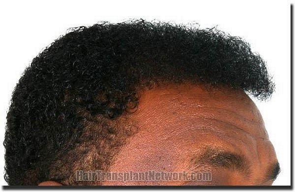 Hair restoration procedure results