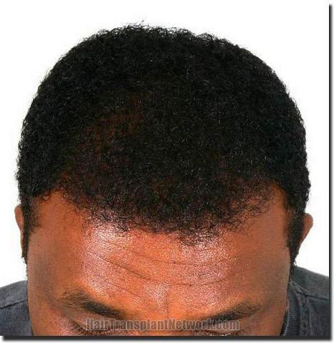 Hair restoration procedure results