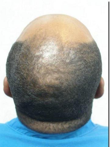 Hair restoration procedure results