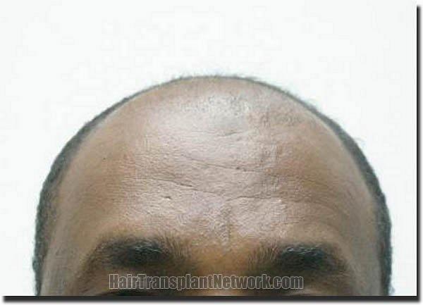 Hair restoration procedure results