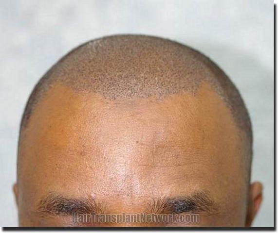 Hair restoration procedure results