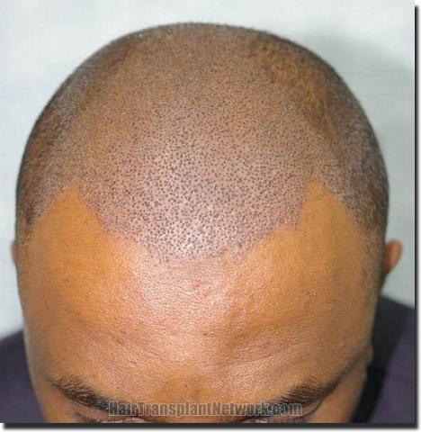 Hair restoration procedure results