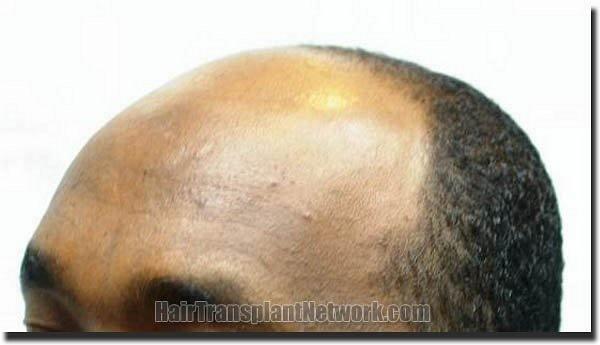 Hair restoration procedure results