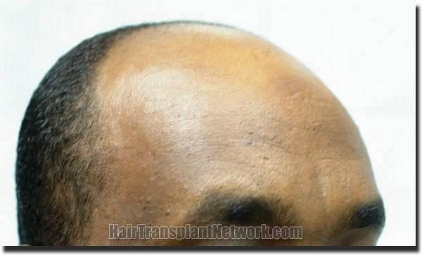 Hair restoration procedure results