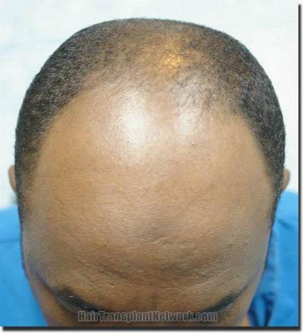 Hair restoration procedure results