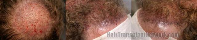 Hair transplantation surgery before and after images