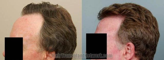  result photos from 2614 grafts