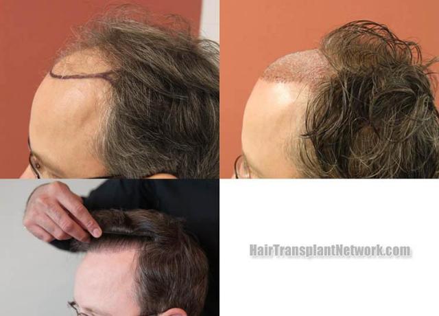 Hair transplantation surgery before and after images