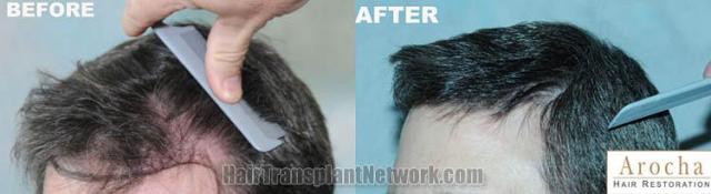 Hair transplantation surgery before and after images