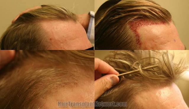 Hair transplantation surgery before and after photos