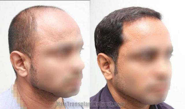 efore and after surgical hair restoration images