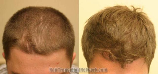 Top view before and after hair restoration results