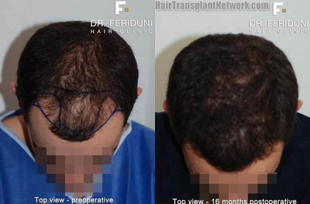 Before and after hair transplant procedure images