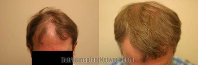 Hair transplantation surgery before and after photos