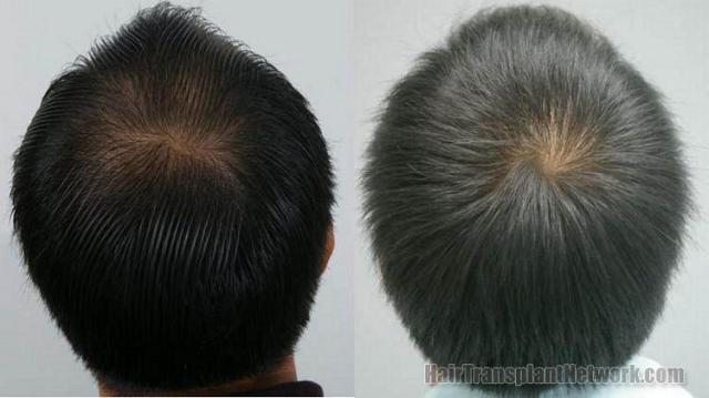 Back view of Thai male from hair replacement