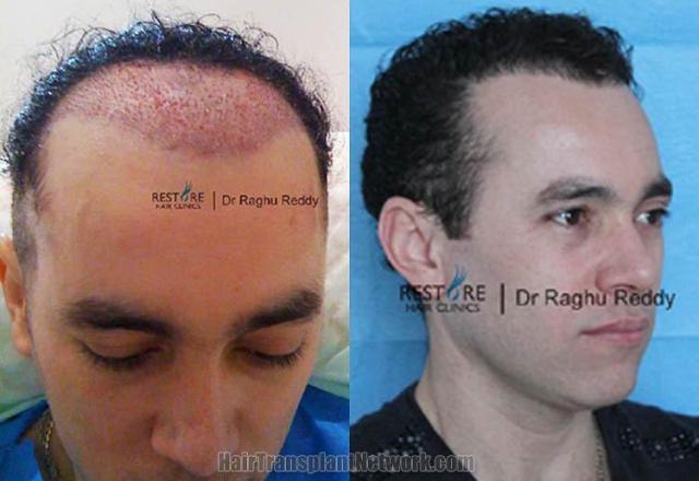 Hair restoration procedure before and after pictures