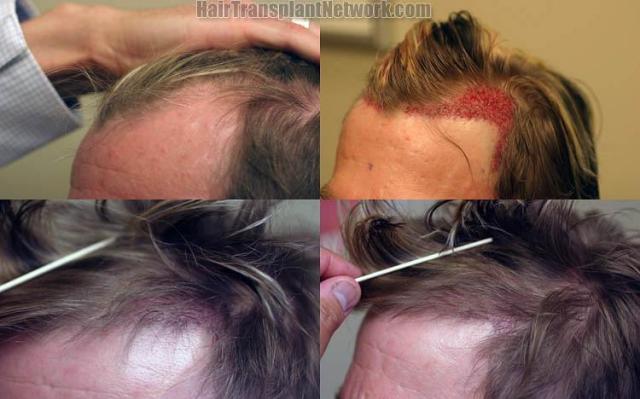 Hair transplantation surgery before and after images