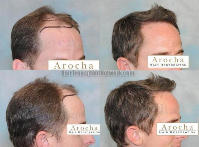 Right view - before and postoperative hair transplant results