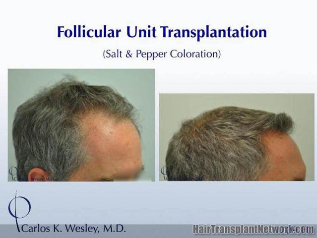 Hair restoration procedure before and after results